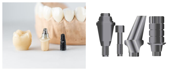 PARS Implants